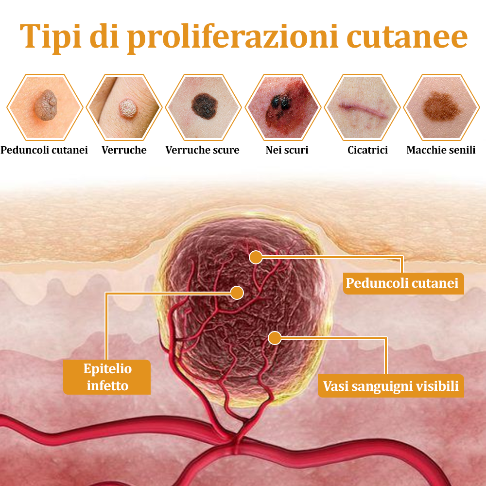 🌟flysmus™ Cura Forte al veleno d'ape: trattamento efficace per verruche, escrescenze cutanee, infezioni e cicatrici, favorisce il rinnovo e la levigatura della pelle irregolare 👨‍⚕️