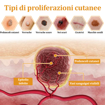 🌟flysmus™ Cura Forte al veleno d'ape: trattamento efficace per verruche, escrescenze cutanee, infezioni e cicatrici, favorisce il rinnovo e la levigatura della pelle irregolare 👨‍⚕️