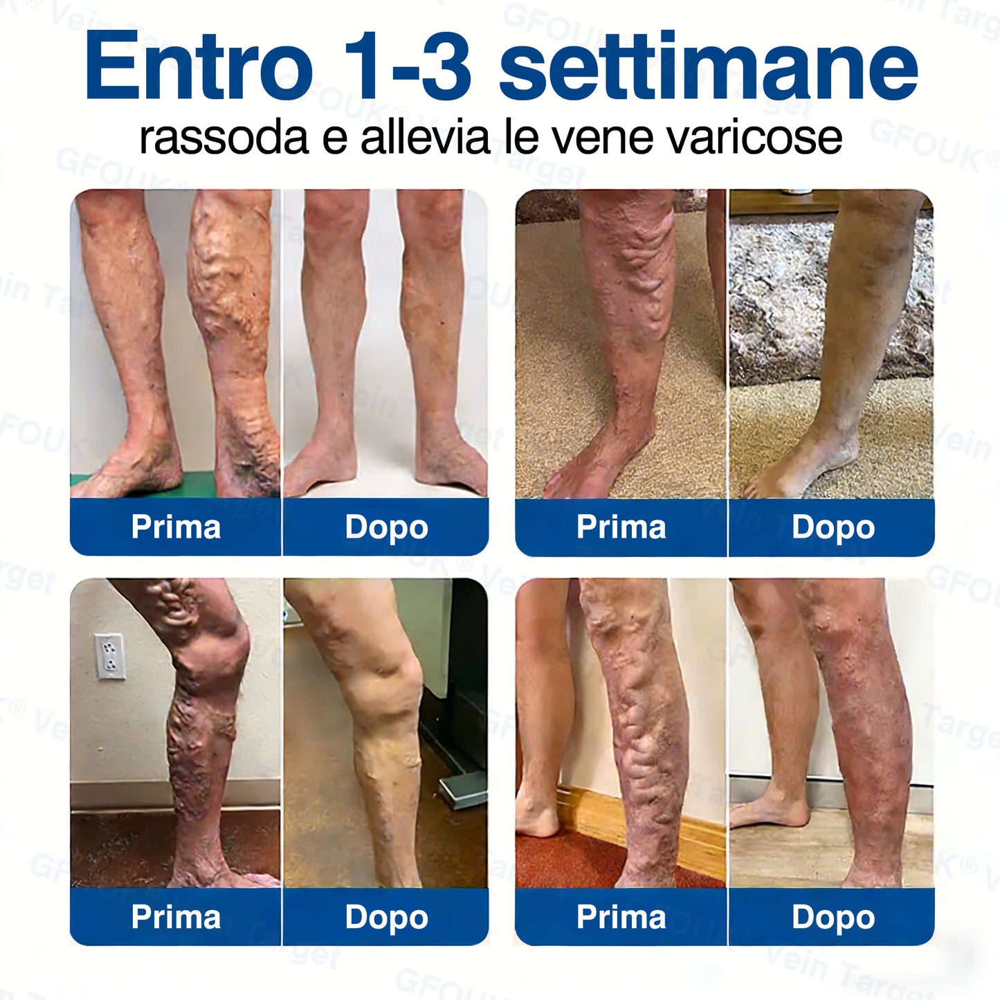 🇮🇹👨‍⚕️✅✅GFOUK® VeinTarget Cerotto a Microaghi⚡Sollievo Immediato, Risultati a Lungo Termine