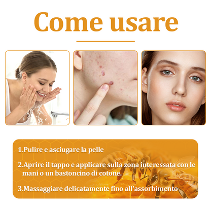 🌟flysmus™ Cura Forte al veleno d'ape: trattamento efficace per verruche, escrescenze cutanee, infezioni e cicatrici, favorisce il rinnovo e la levigatura della pelle irregolare 👨‍⚕️