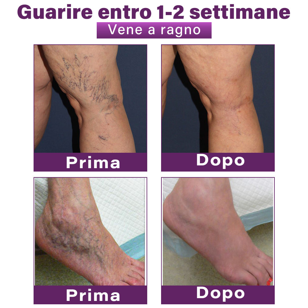 ✅ GFOUK® Cerotto Nano Varicose con Polidocanolo 👩🏼‍⚕️ Raccomandato dalla Società Italiana di Chirurgia Vascolare (Per Varici, Vene Varicose e Gonfiore alle Gambe)