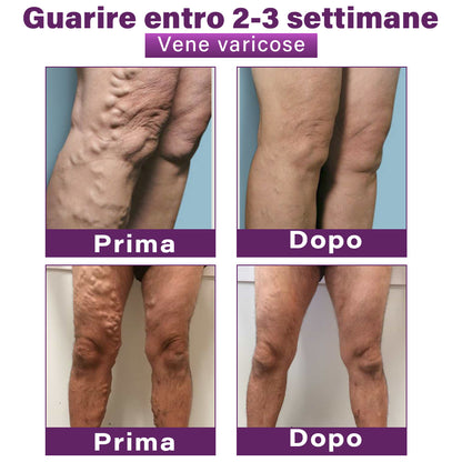 ✅ GFOUK® Cerotto Nano Varicose con Polidocanolo 👩🏼‍⚕️ Raccomandato dalla Società Italiana di Chirurgia Vascolare (Per Varici, Vene Varicose e Gonfiore alle Gambe)