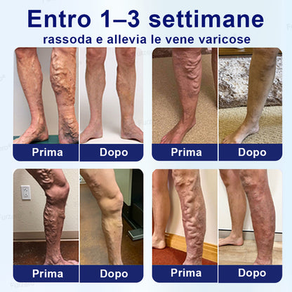 Certificato AIFA✅Prodotto e spedito dall'Italia🌿Furzero® VeinFreedom Spray alle Erbe - Terapia con micro-nebbia