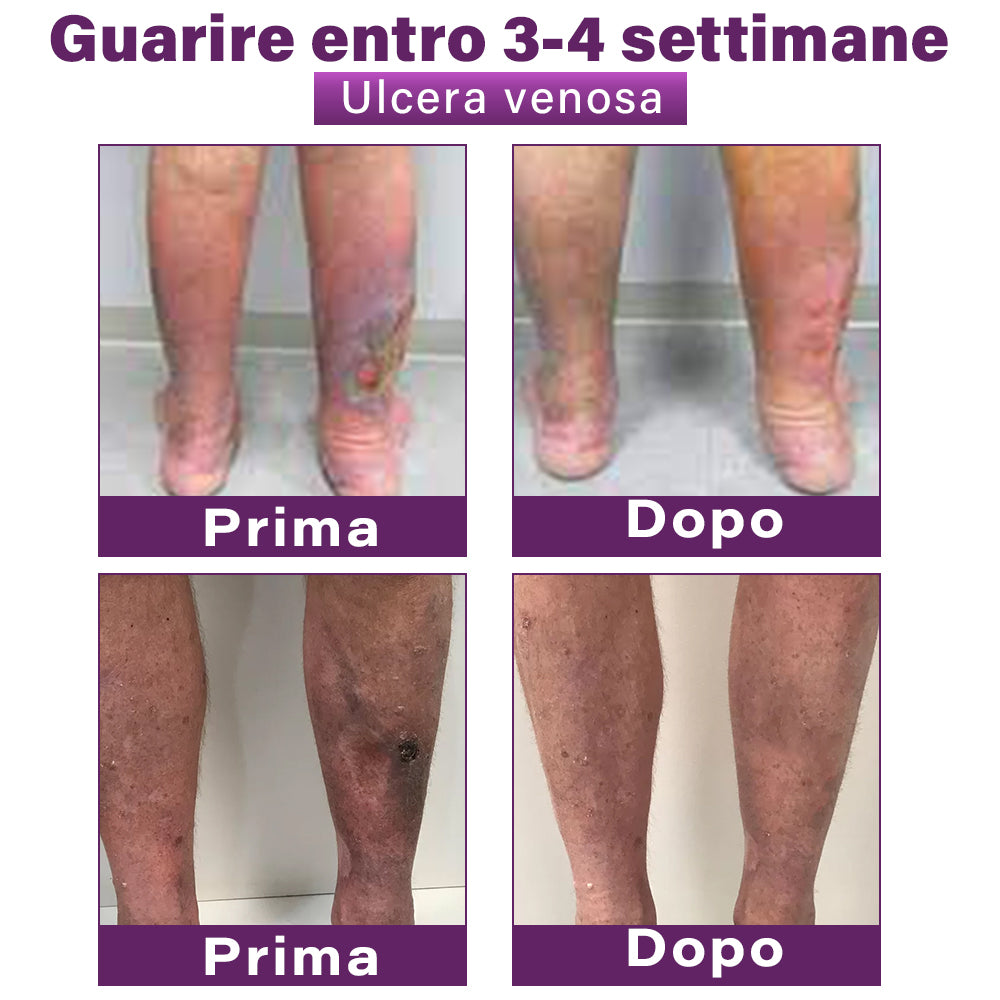 ✅ GFOUK® Cerotto Nano Varicose con Polidocanolo 👩🏼‍⚕️ Raccomandato dalla Società Italiana di Chirurgia Vascolare (Per Varici, Vene Varicose e Gonfiore alle Gambe)