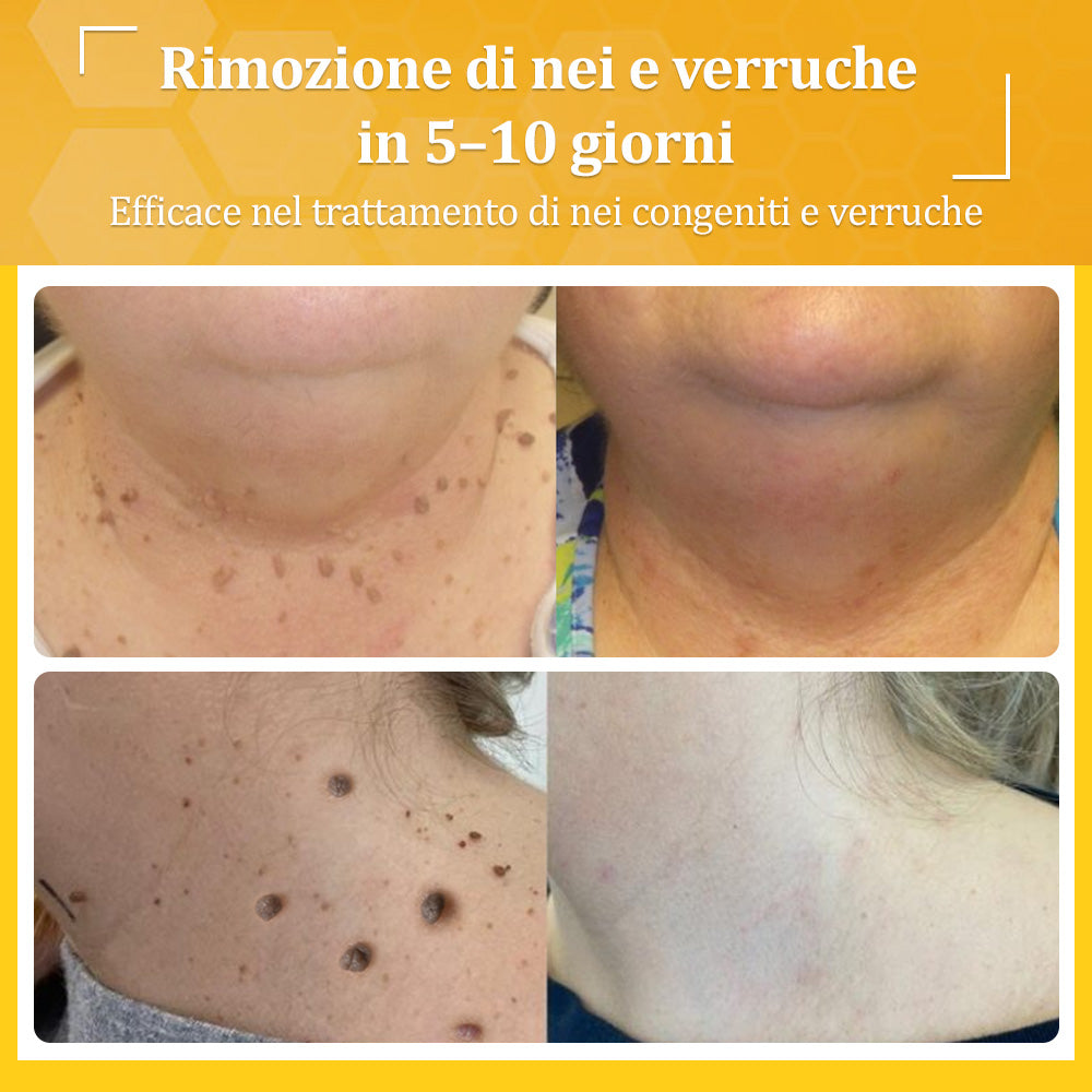 🍀flysmus® Crema al Veleno d’Ape – Testata da dermatologi. Efficace contro verruche, noduli, lesioni, infezioni e cicatrici.