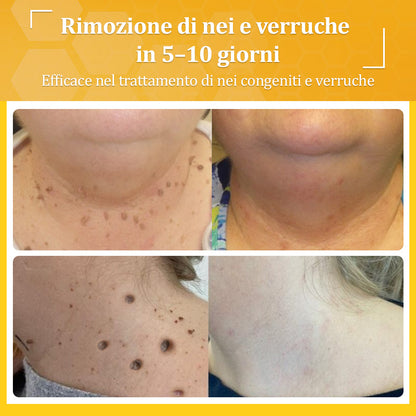 🍀flysmus® Crema al Veleno d’Ape – Testata da dermatologi. Efficace contro verruche, noduli, lesioni, infezioni e cicatrici.