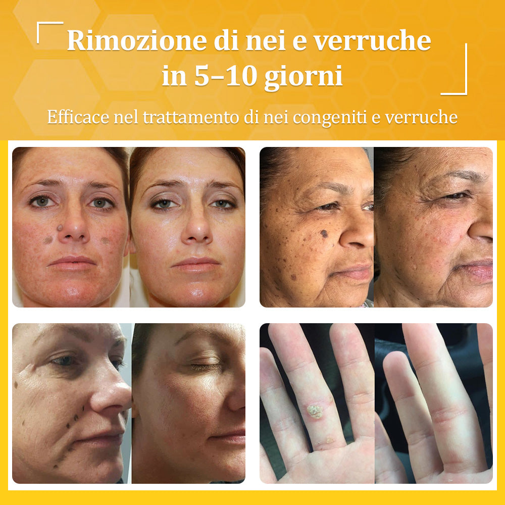 🍀flysmus® Crema al Veleno d’Ape – Testata da dermatologi. Efficace contro verruche, noduli, lesioni, infezioni e cicatrici.