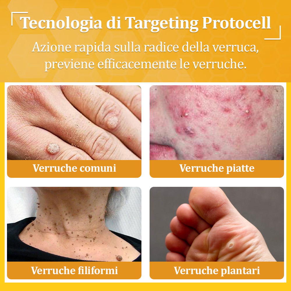 🌟flysmus™ Cura Forte al veleno d'ape: trattamento efficace per verruche, escrescenze cutanee, infezioni e cicatrici, favorisce il rinnovo e la levigatura della pelle irregolare 👨‍⚕️
