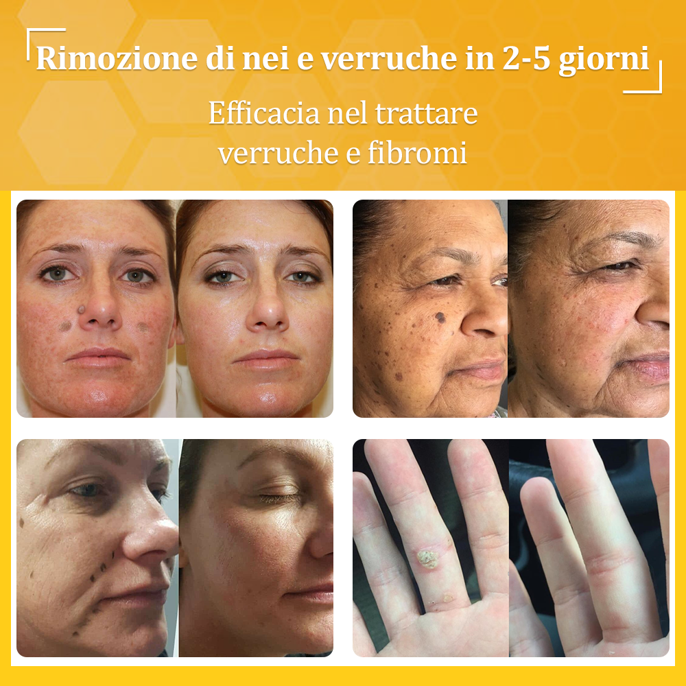 🌟flysmus™ Cura Forte al veleno d'ape: trattamento efficace per verruche, escrescenze cutanee, infezioni e cicatrici, favorisce il rinnovo e la levigatura della pelle irregolare 👨‍⚕️