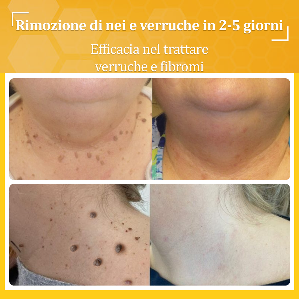 🌟flysmus™ Cura Forte al veleno d'ape: trattamento efficace per verruche, escrescenze cutanee, infezioni e cicatrici, favorisce il rinnovo e la levigatura della pelle irregolare 👨‍⚕️